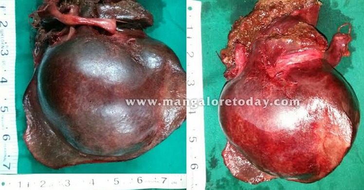 liver
